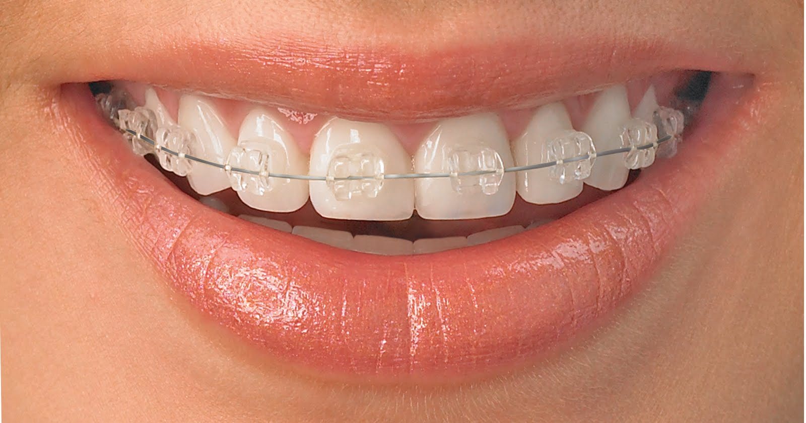 Sorriso com aparelho ortodôntico estético