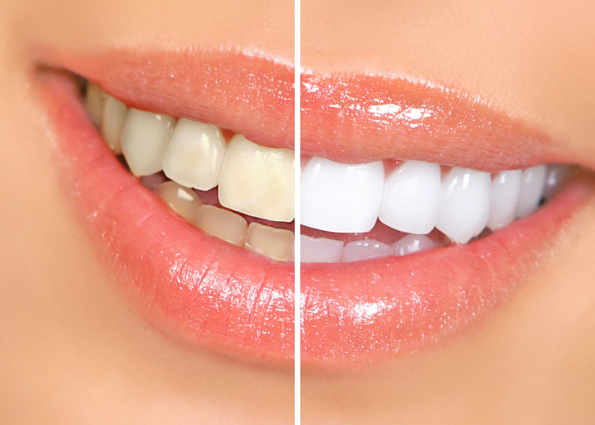 Sorriso antes e depois do clareamento dental