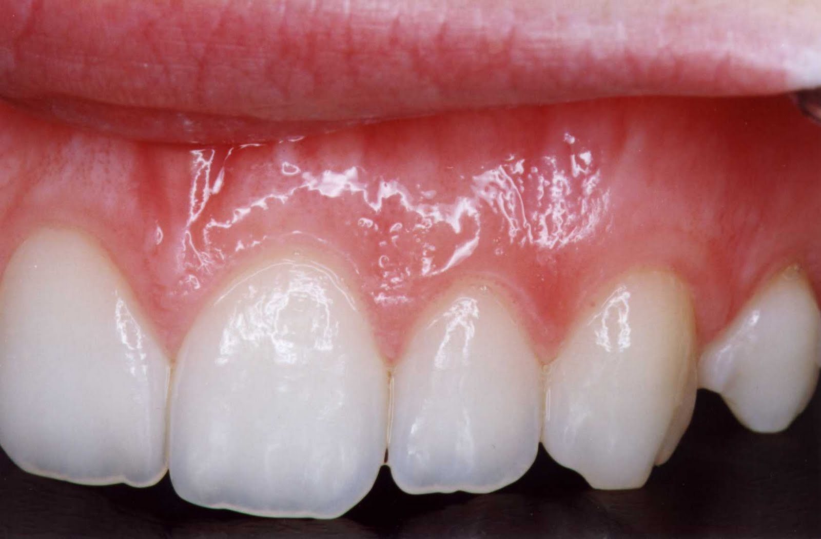 Dentes e gengiva saudáveis