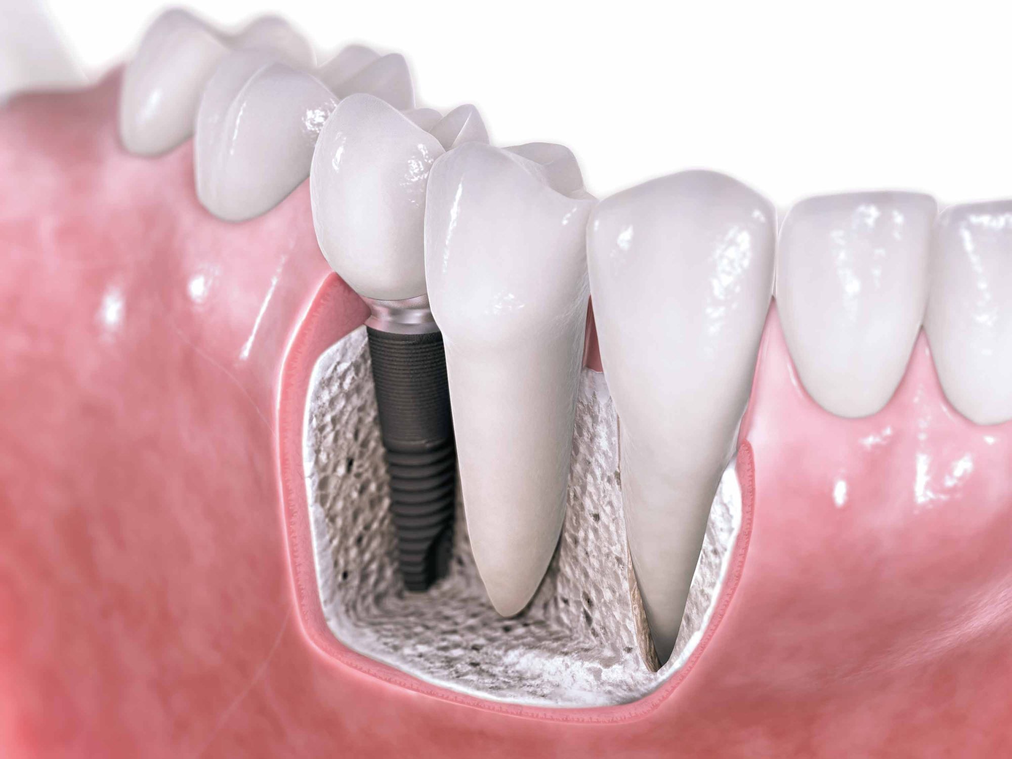 Ilustração de implante dentário integrado ao osso